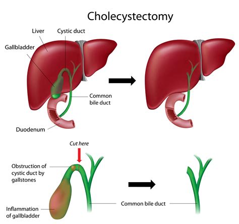 Overcome the Discomfort of Bloating After a Cholecystectomy
